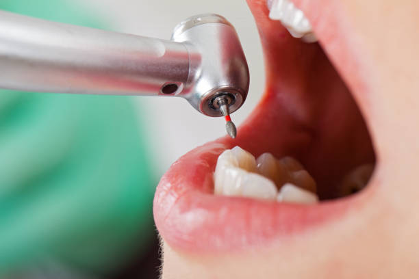 Best Broken or Cracked Tooth Emergency Dentist in Hannibal, MO